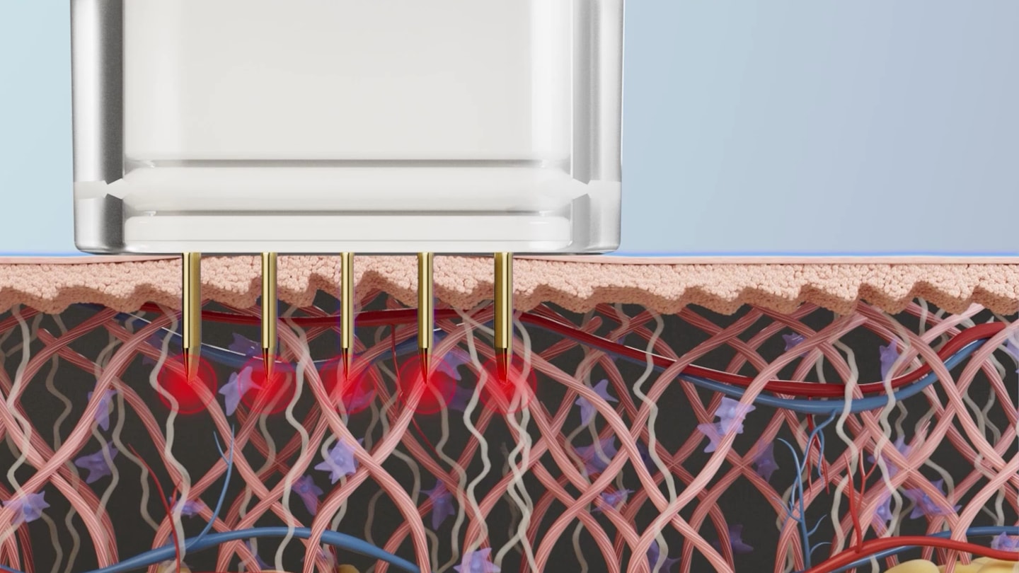 Cross-section illustration of Potenza needles in the dermis with coagulation zones at their tips