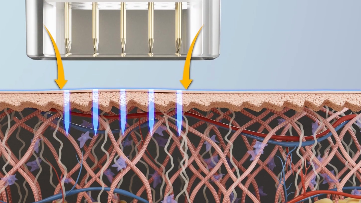 Cross-section illustration of the Potenza pumping tip pushing a topical down the needle channels