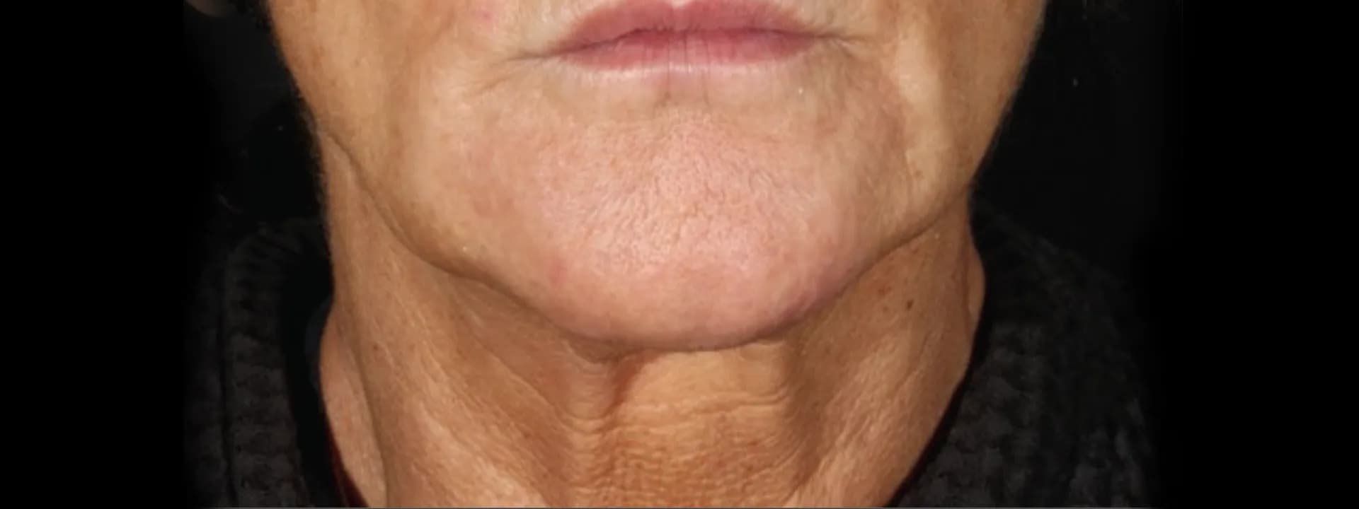 After two XERF treatments: the same patient’s lower face and neck, front view