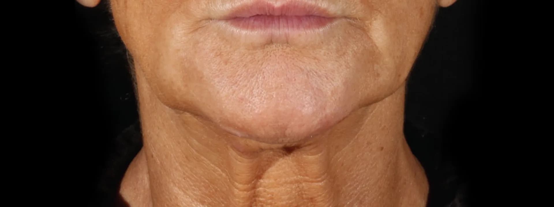 Before XERF: the lower face and neck of a patient, front view