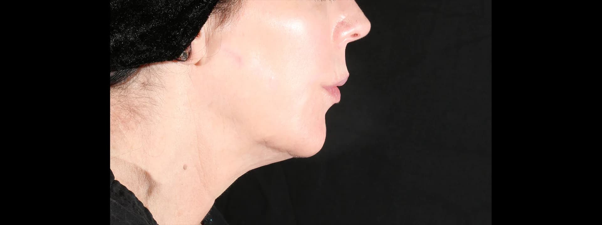 After two XERF treatments: the same patient’s jawline and neck