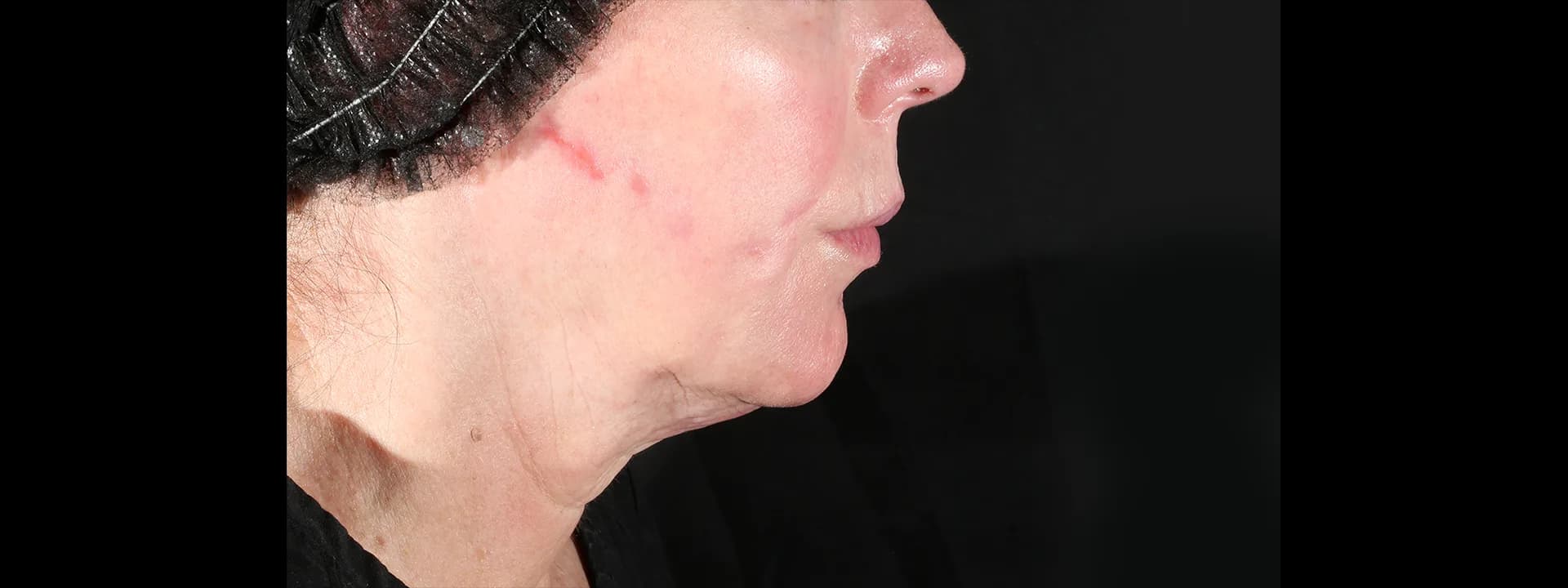 Before XERF: a patient’s jawline and neck