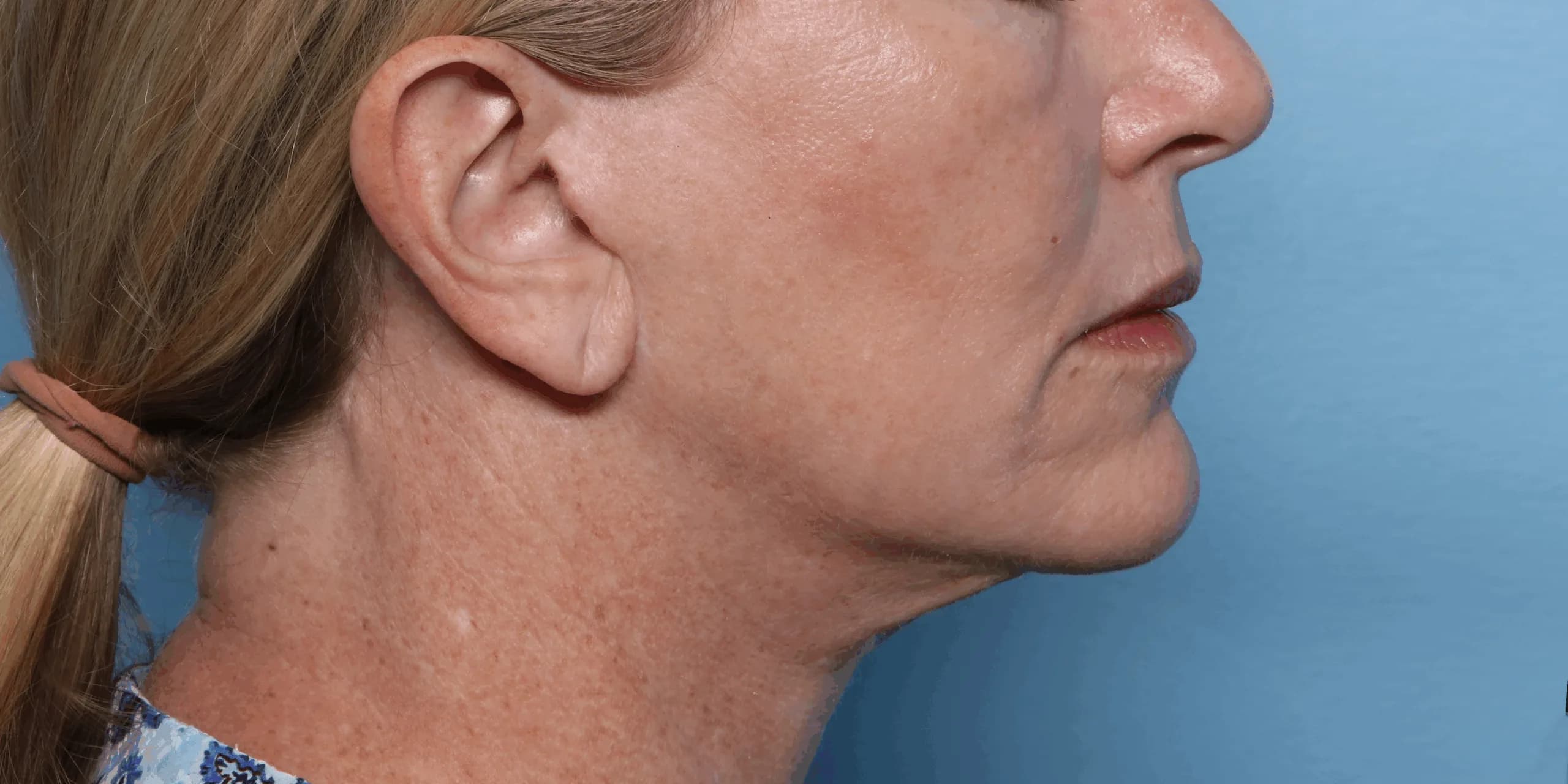 Four weeks after XERF: the same patient’s jawline and neck in profile