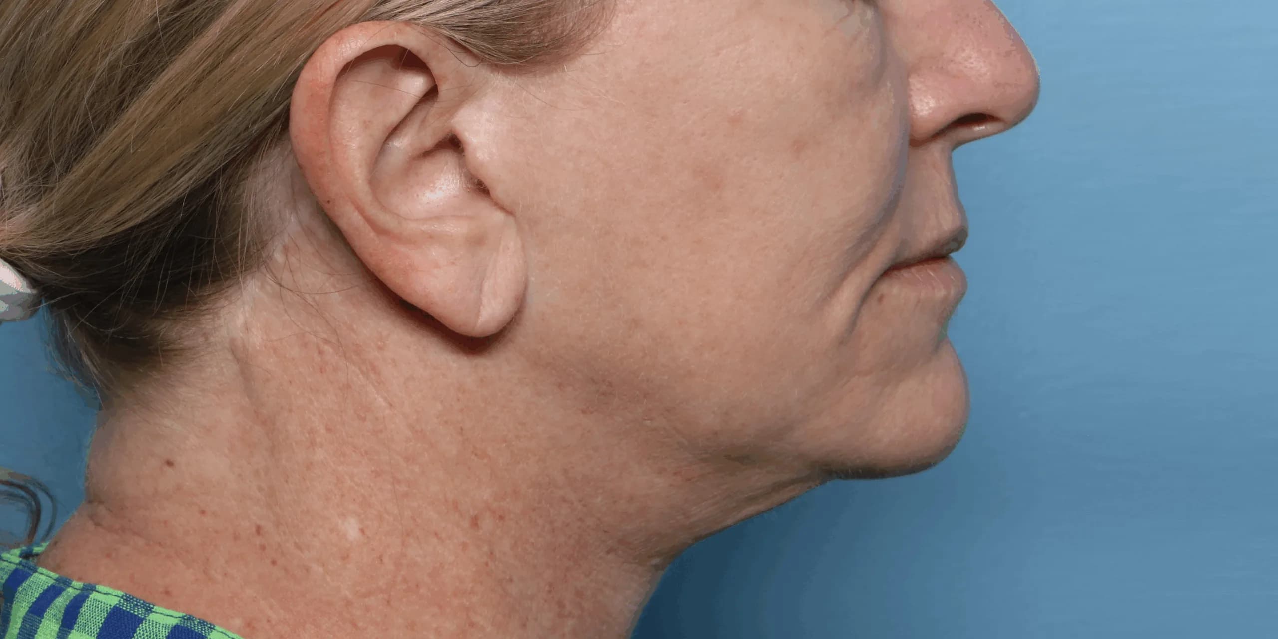 Before XERF: a patient’s jawline and neck in profile