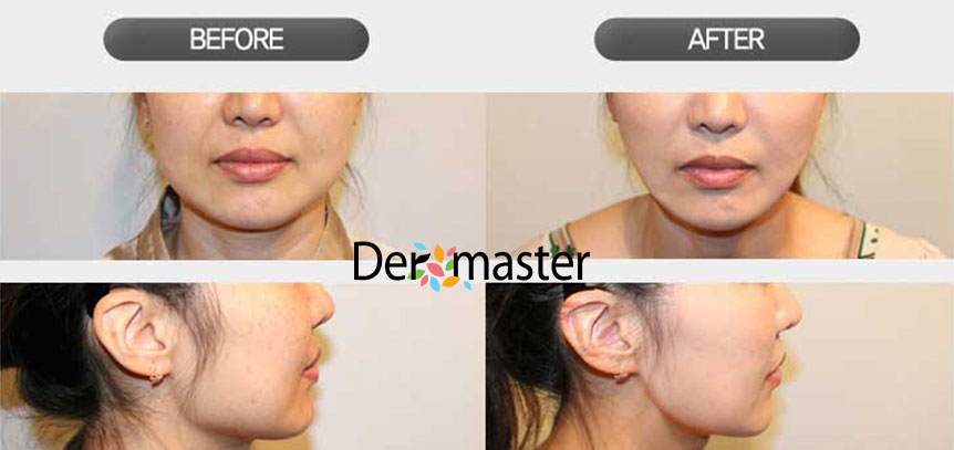 Dermaster USA TuneFace_before-and-after-12