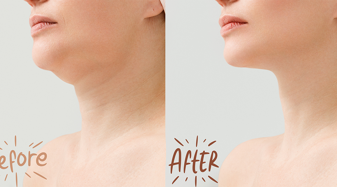 Achieve the Perfect V-Line: Non-Surgical Facial Contouring with Chin Botox & Fillers at Dermaster Aesthetic Medical Clinic