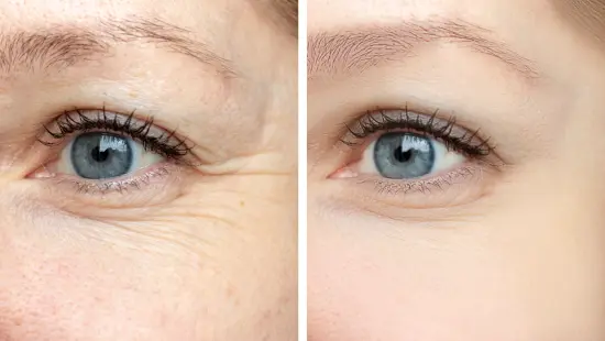 Woman face, eye wrinkles before and after treatment - the result of rejuvenating cosmetological procedures of biorevitalization, botox and pigment spots remova